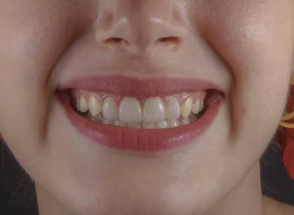 After Smile Design