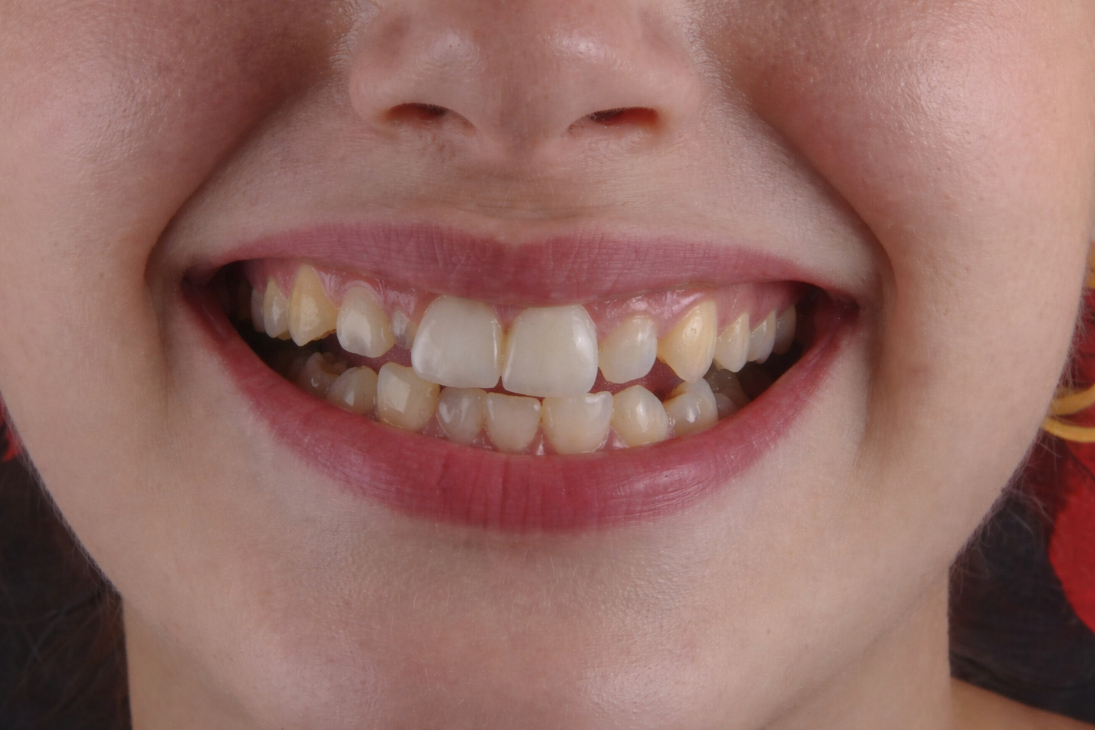 Before Smile Design