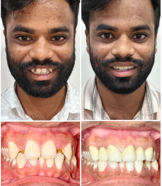 Smile Transformation