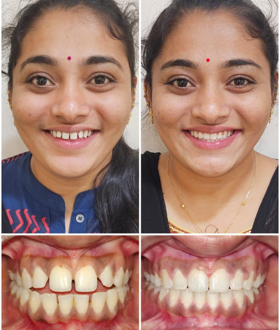 Smile Transformation
