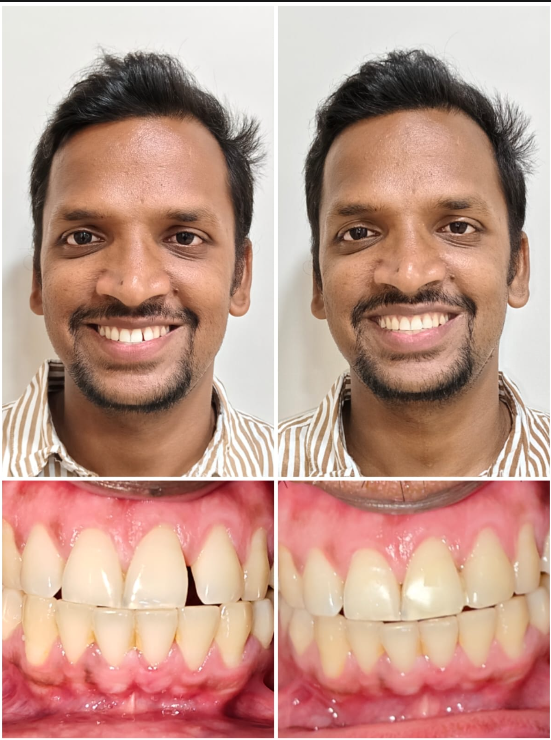 Smile Transformation