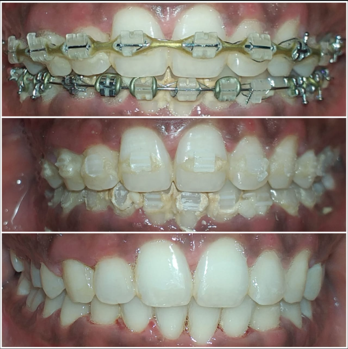 Smile Transformation