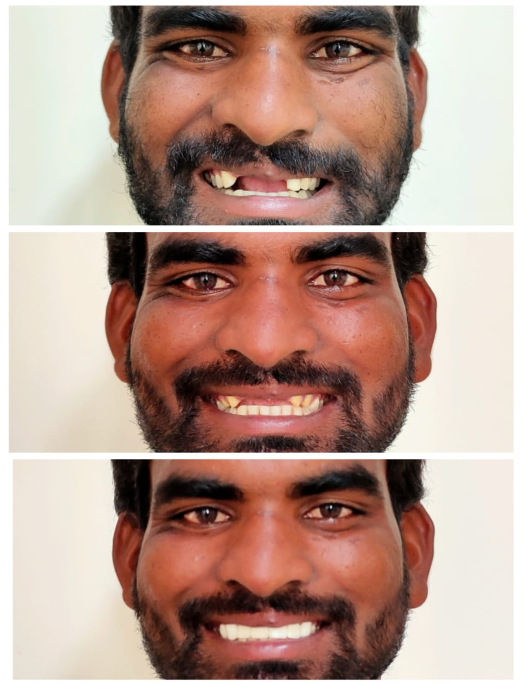 Smile Transformation